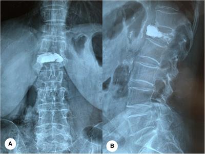 Risk factors for bone cement displacement after percutaneous vertebral augmentation for osteoporotic vertebral compression fractures